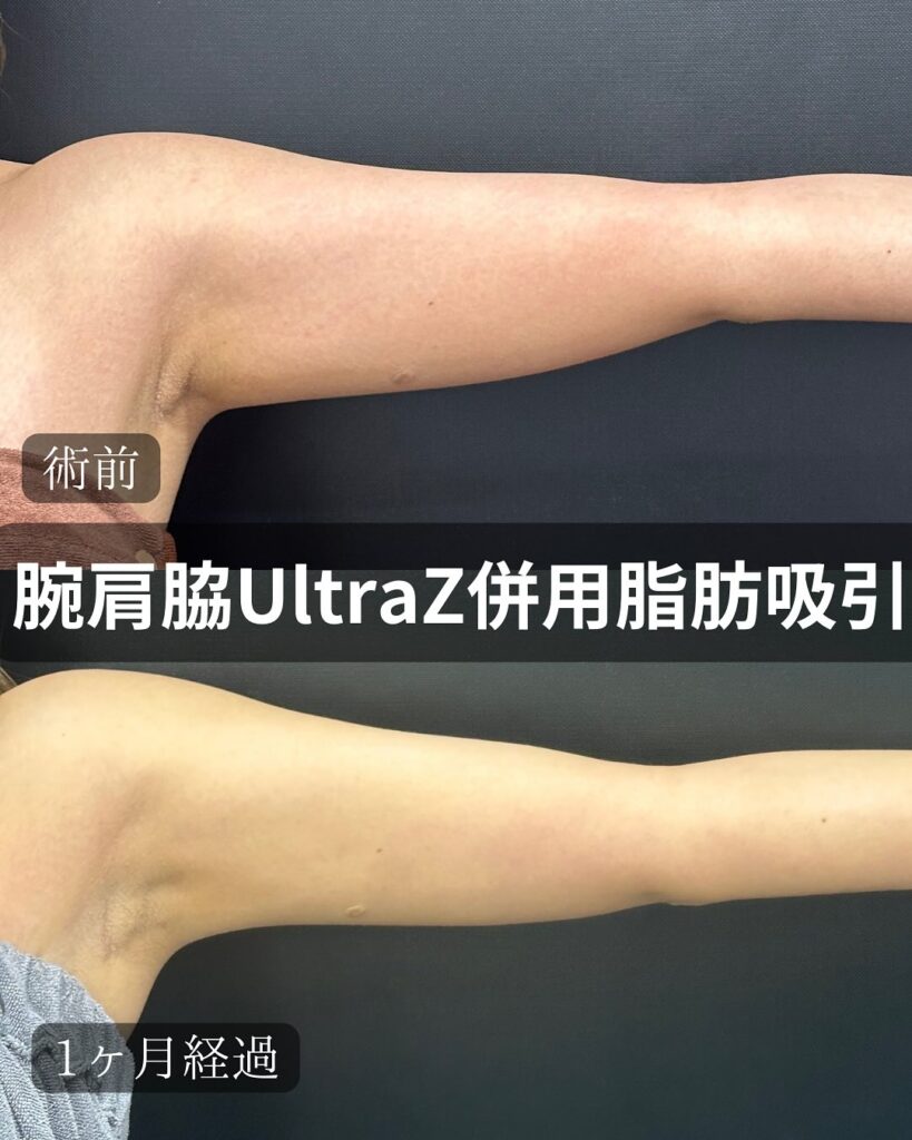 二の腕と肩の脂肪吸引の症例写真 (1)