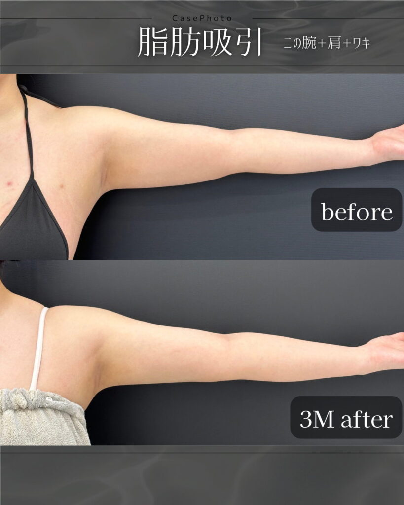 二の腕と肩と脇の脂肪吸引の症例