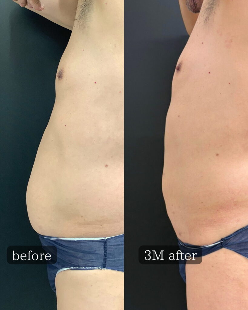 アキーセル脂肪吸引を受けた男性の症例写真