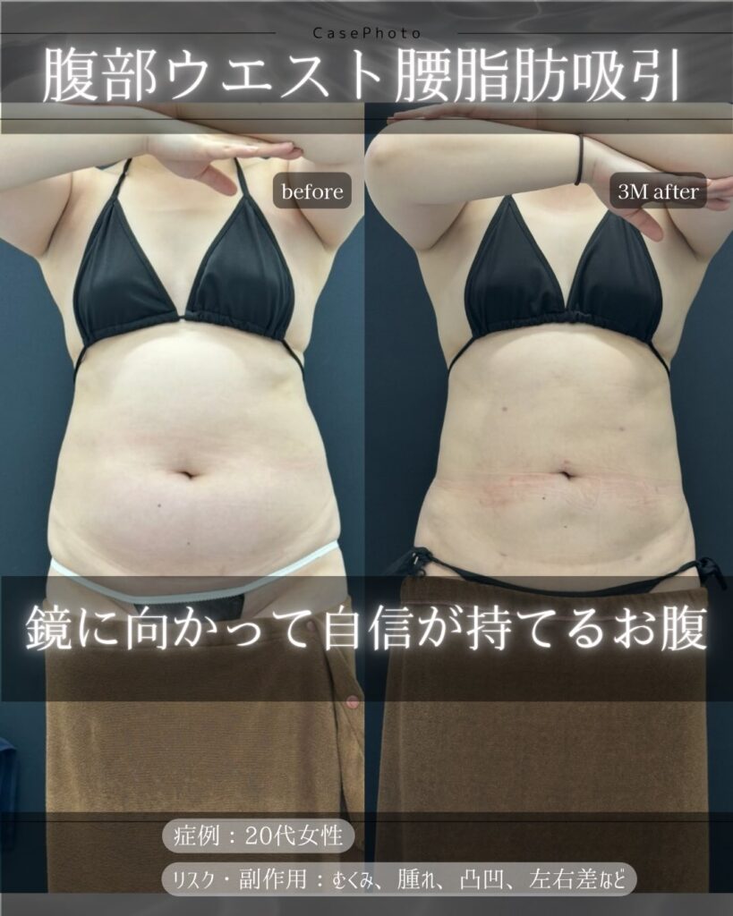 腹部ウエストと腰の症例写真