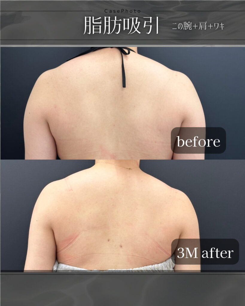 二の腕肩と脇の脂肪吸引の症例写真