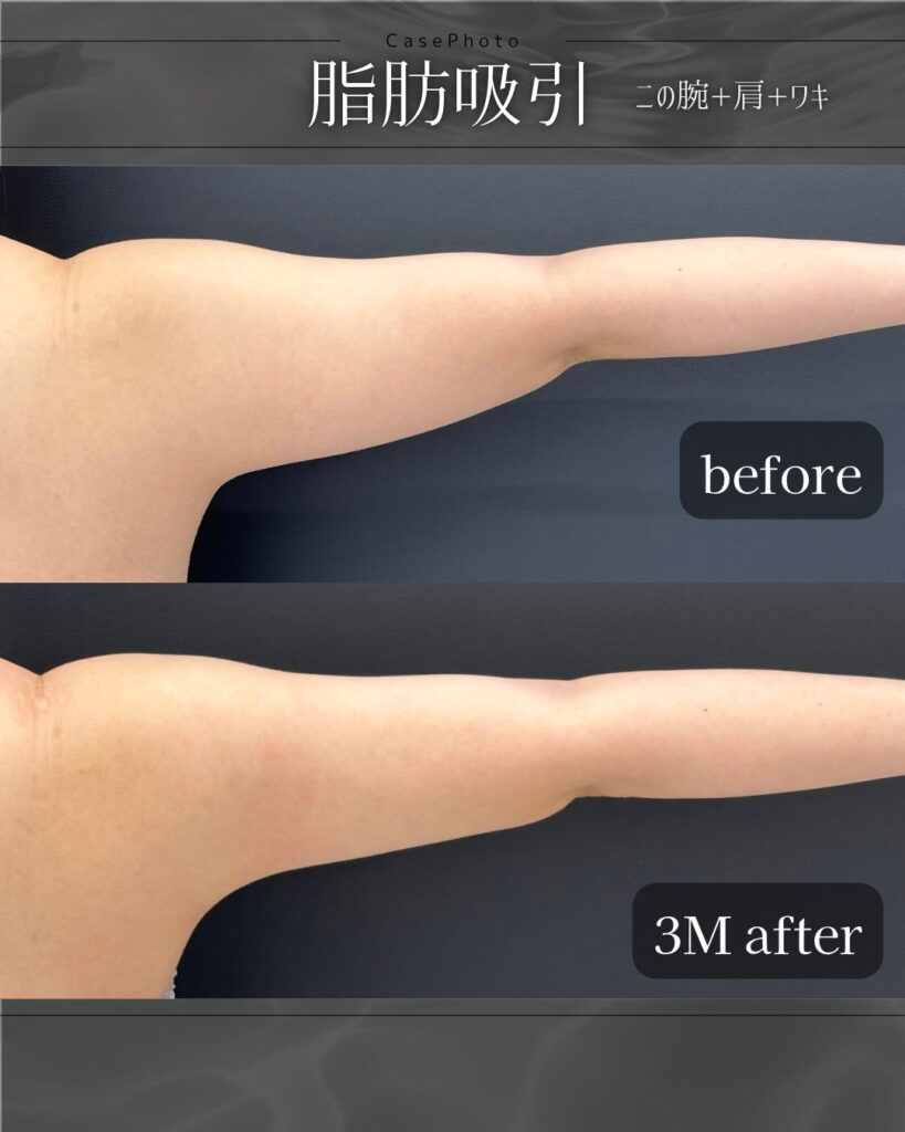 二の腕と肩と脇の症例写真1