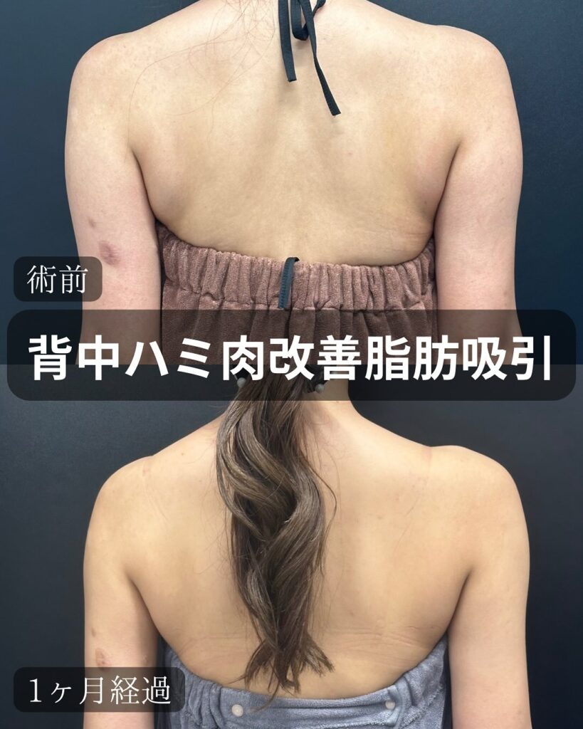 背中のハミ肉改善の脂肪吸引の症例写真