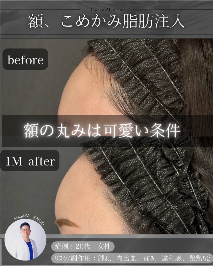 額とこめかみの脂肪注入の症例写真 (9)
