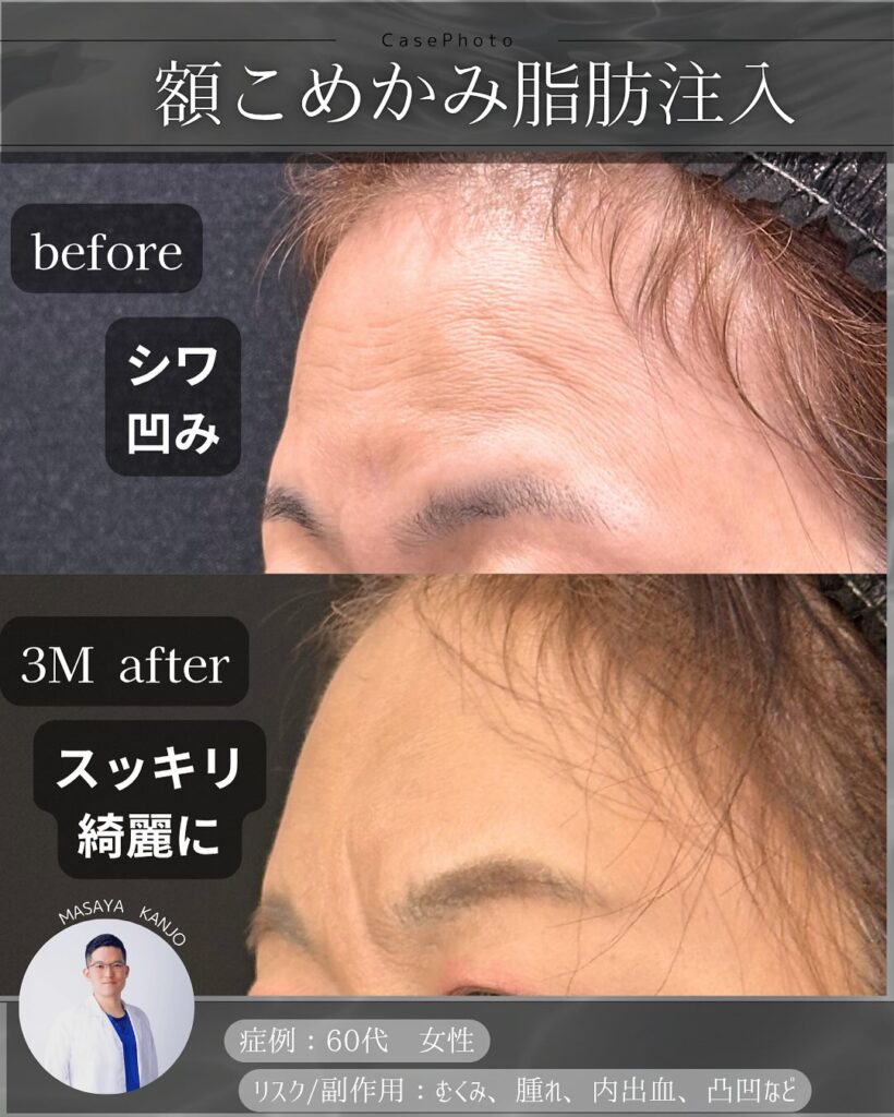 額とこめかみの脂肪注入の症例写真 (2)