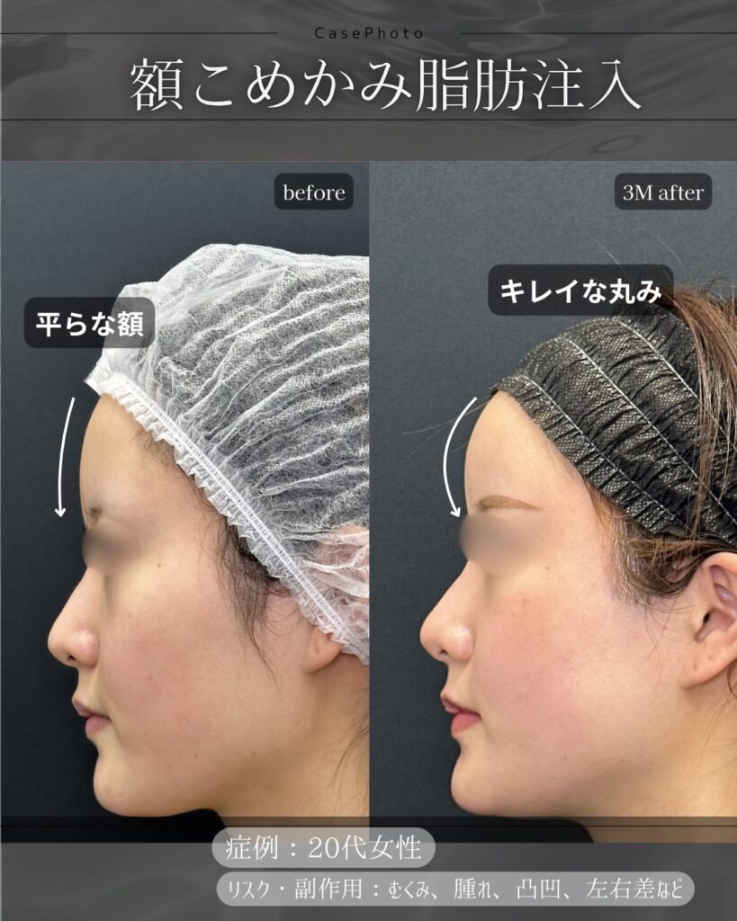 額の脂肪注入の症例写真 (4)