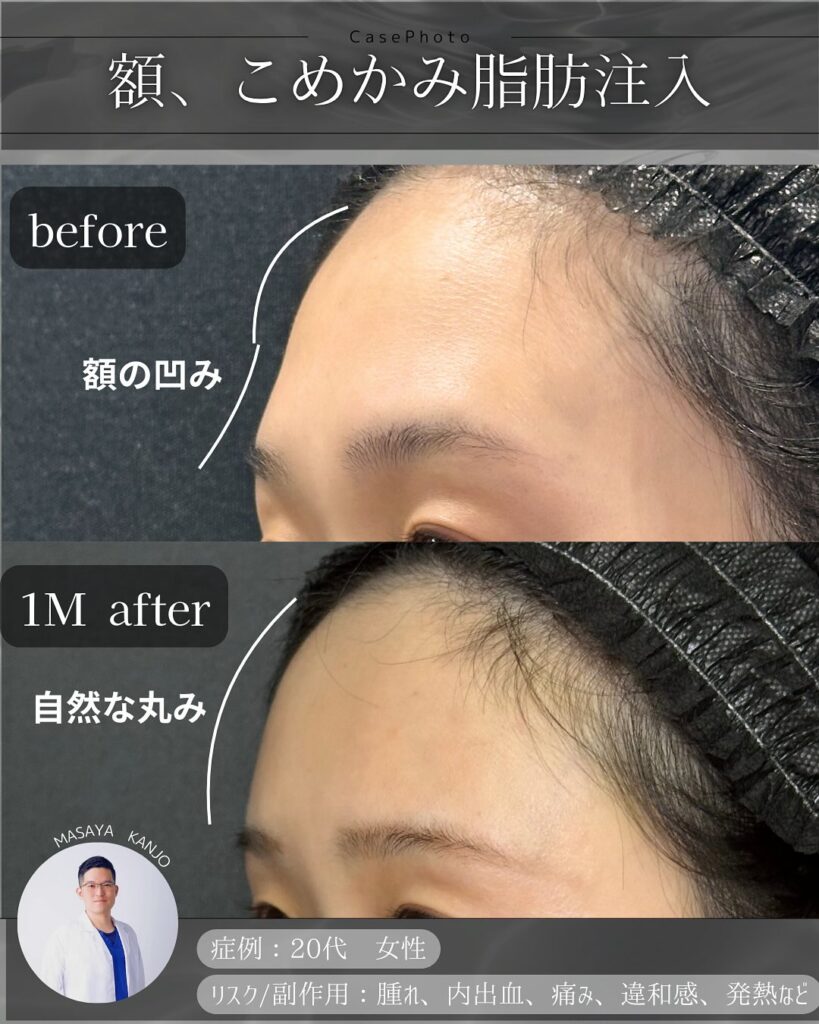 額とこめかみの脂肪注入の症例写真 (11)
