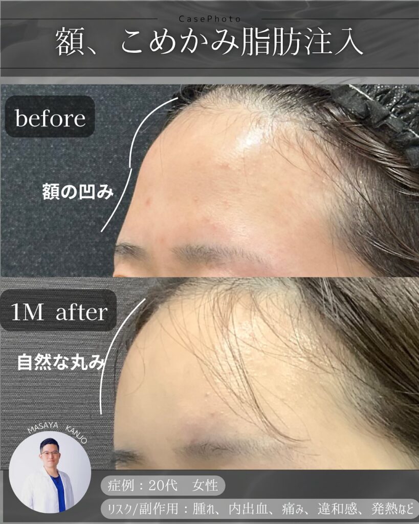 額とこめかみの脂肪注入の症例写真 (4)