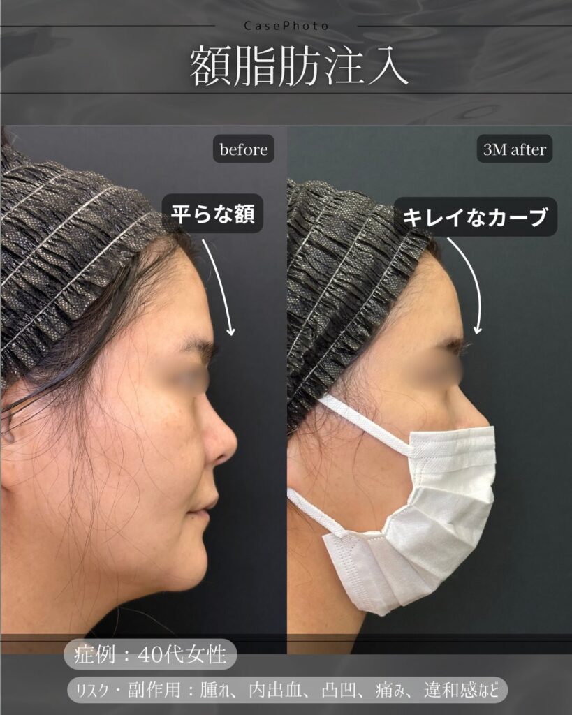 額の脂肪注入の症例写真 (2)