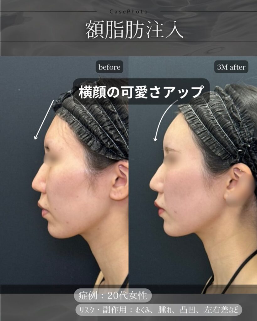 額の脂肪注入の症例写真 (2)