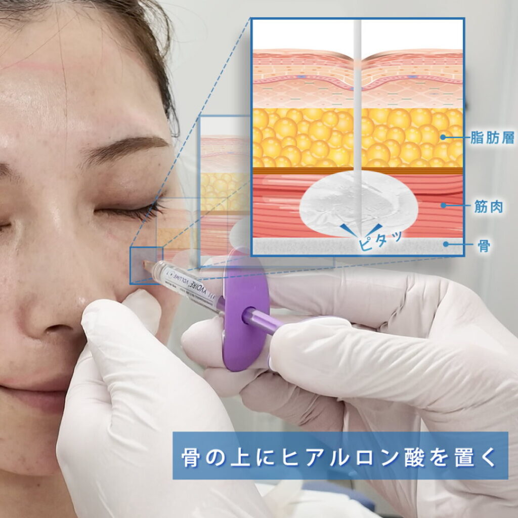 ヒアルロン酸をゴルゴラインの骨膜上に注入している図解