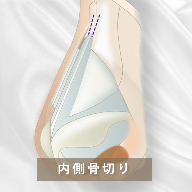 内側骨切りの図解