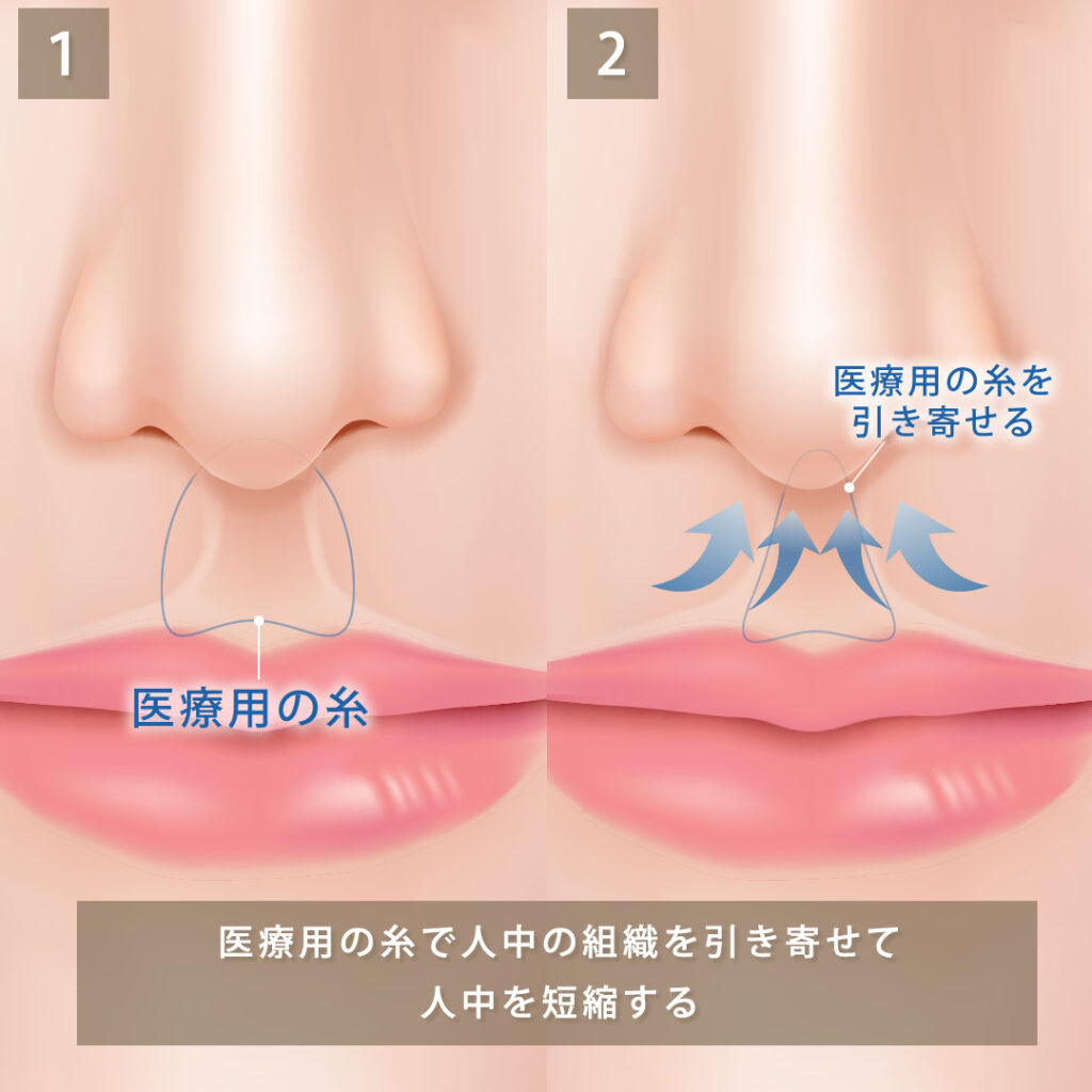 切らない人中短縮の図解