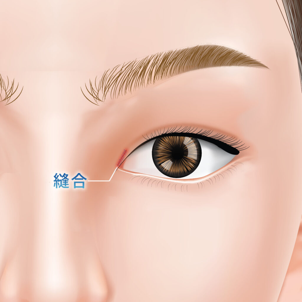 目上切開で縫合している図解