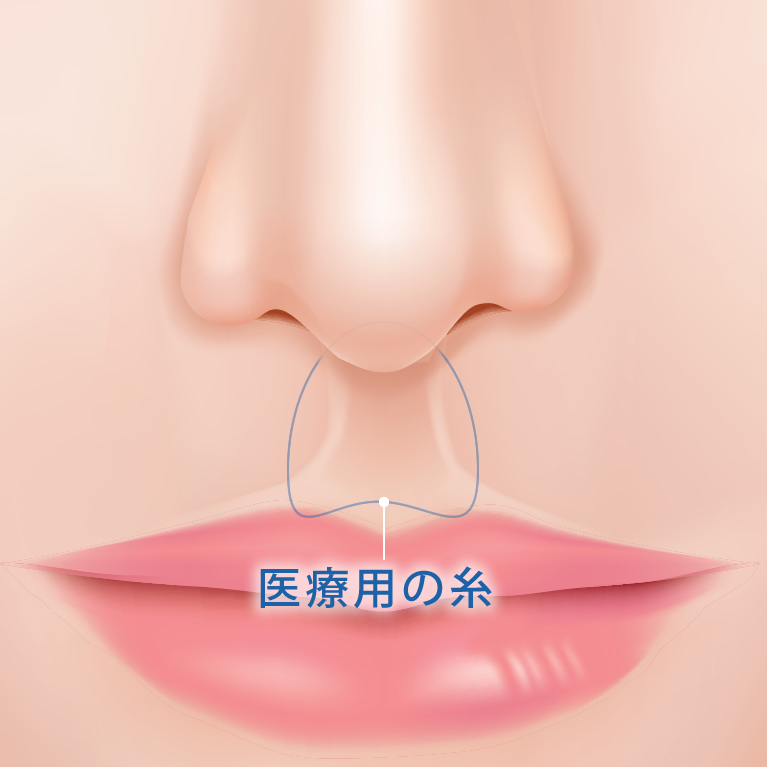 タッキング法による切らない人中短縮で糸を挿入している図解