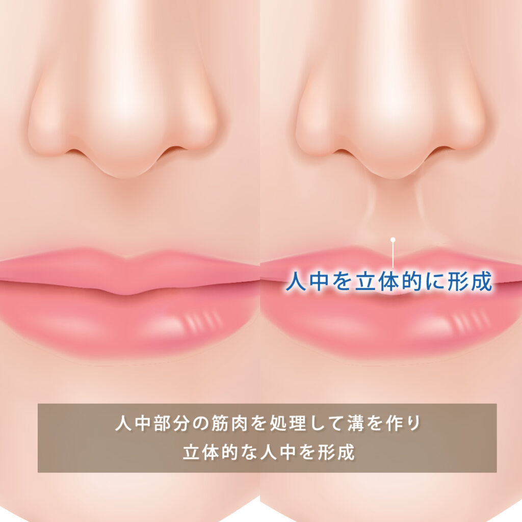 人中窩形成の図解.