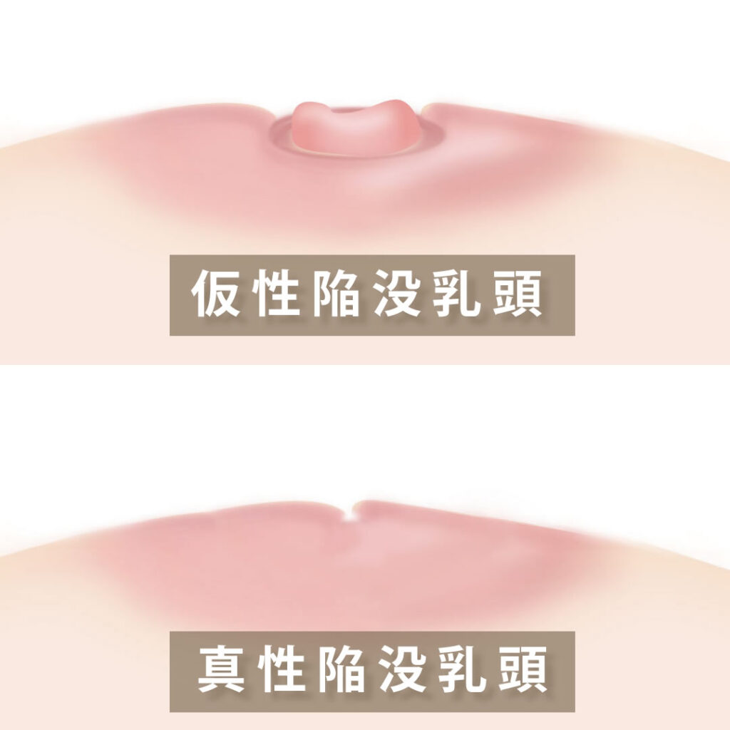 仮性陥没乳頭と真性陥没乳頭の違いの図解