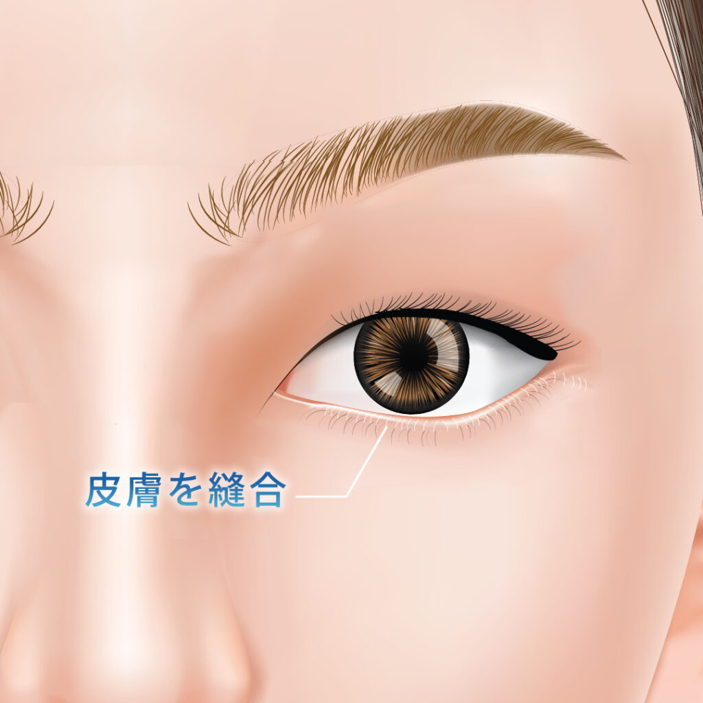 下まつ毛の生え際の皮膚を縫合している図解