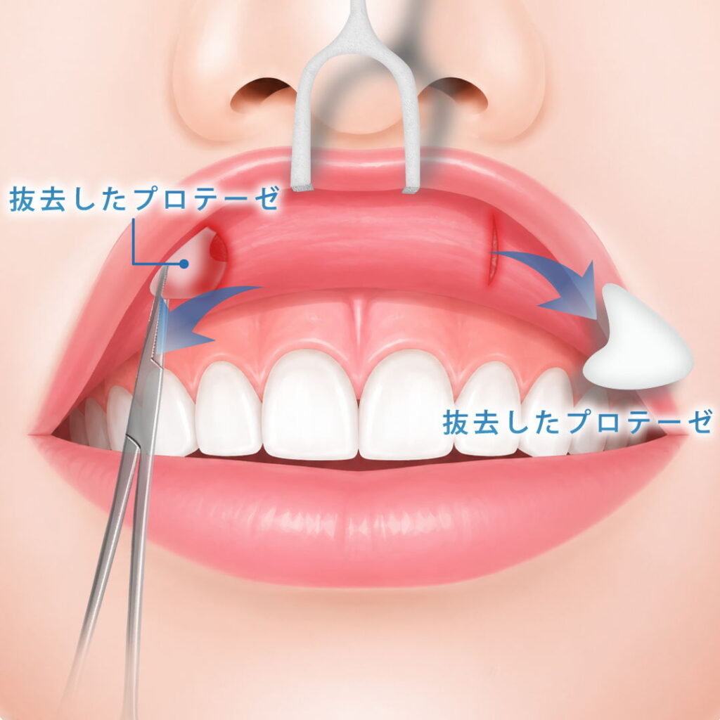 貴族手術でプロテーゼを口腔内から抜去している図解