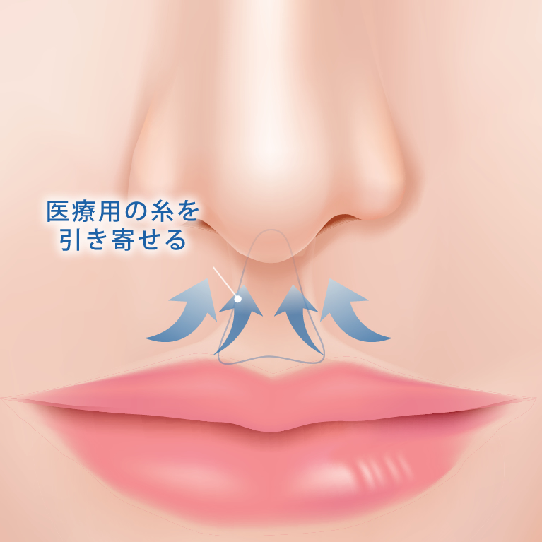 切らない人中短縮のタッキング法で手術中に糸を引き寄せている図解