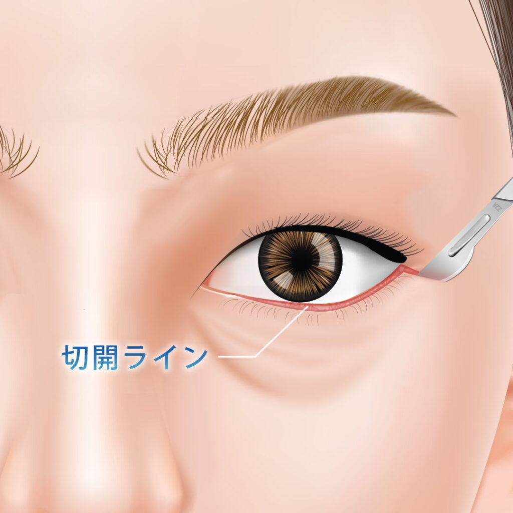 ディープミッドフェイスリフトで下まつ毛の生え際を切開している図解