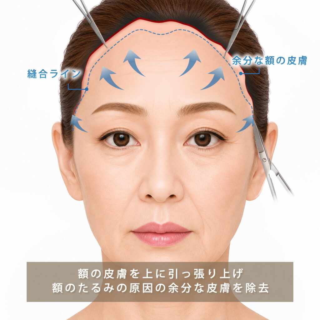 前頭筋不動化で余分な皮膚を除去する様子