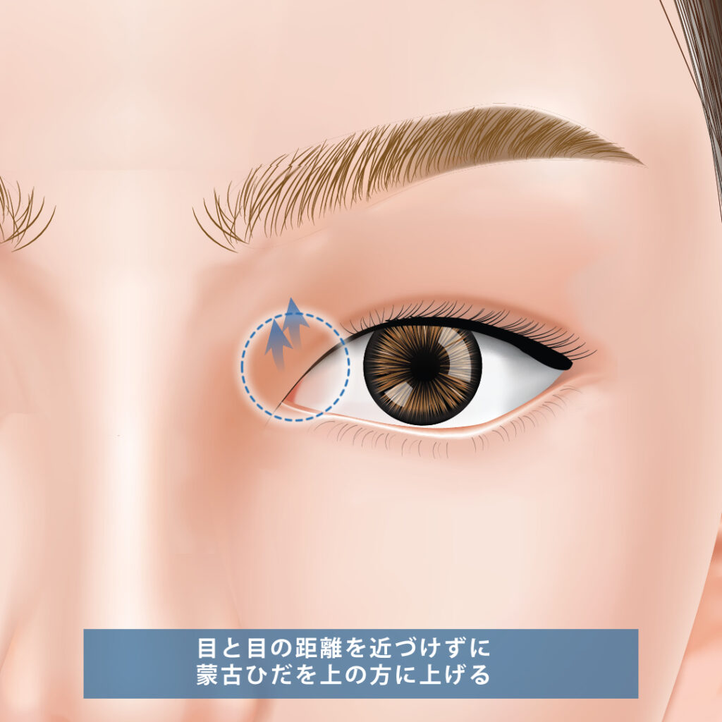 目上切開の図解
