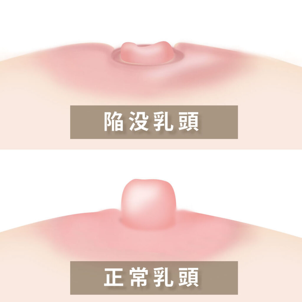乳頭陥没と正常乳頭の違い