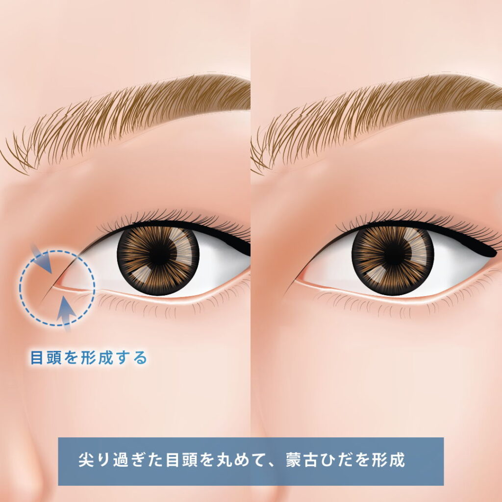 目頭形成の手術イメージ