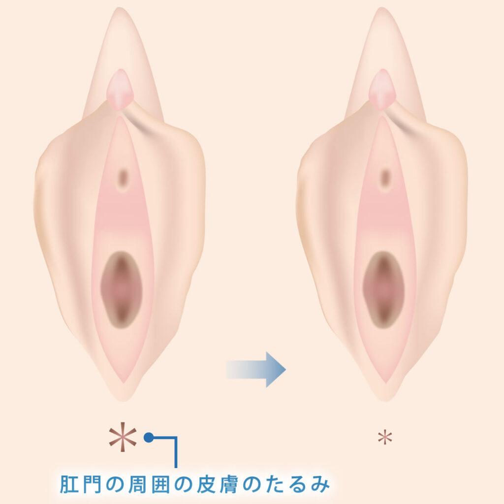 肛門周囲余剰皮膚切除のイメージ
