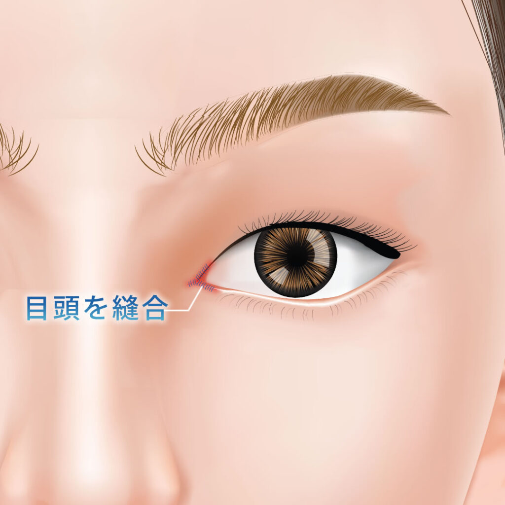 目頭を縫合