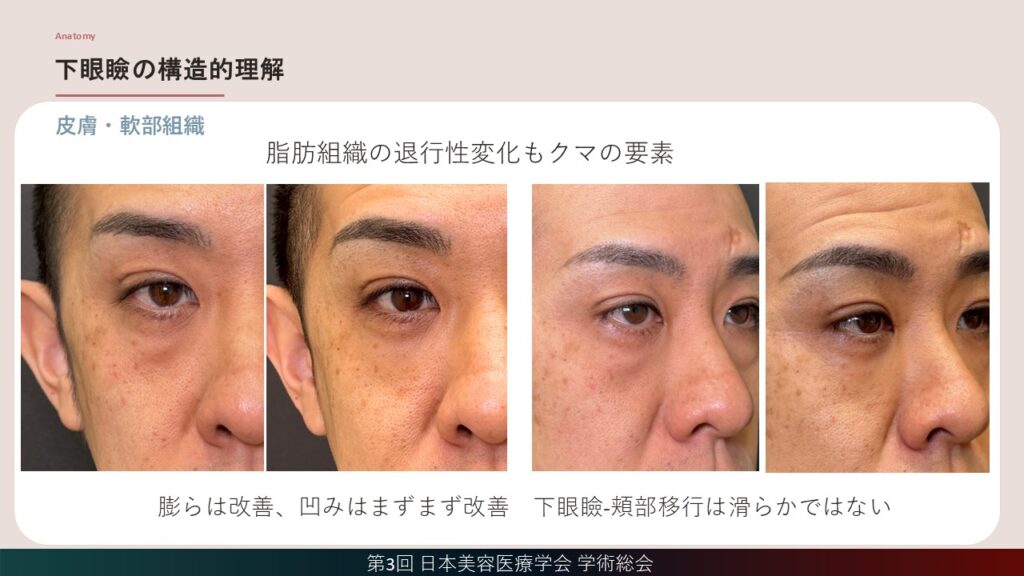 12_提案術式は裏ハムラ＋脂肪注入の症例2