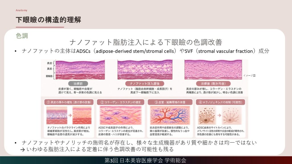 15_ナノファット脂肪注入による下眼瞼の色調改善